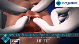 frenectomy procedure