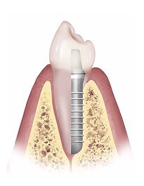 Implant-Image - Integrative Dental Of Denver