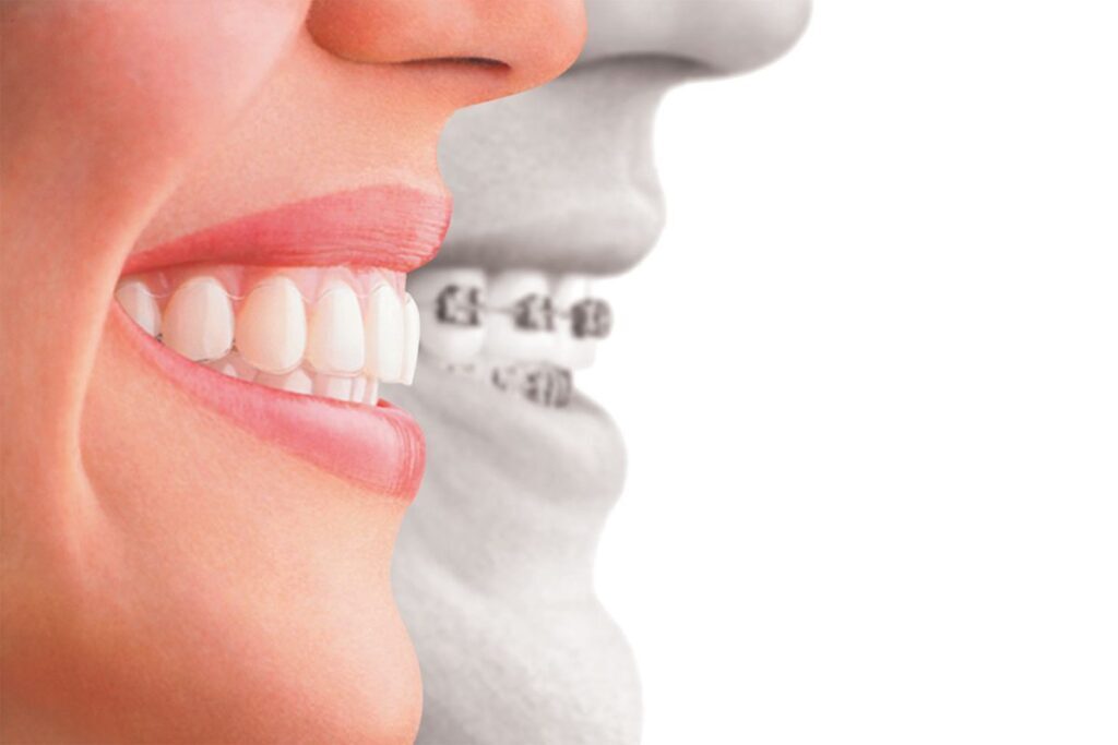 Invisalign 1 - Integrative Dental Of Denver