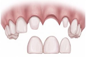 Bridge-1 - Integrative Dental Of Denver