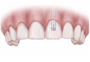 Crown-1 - Integrative Dental Of Denver